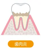 歯肉炎