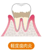 軽度歯肉炎