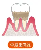 中度歯肉炎