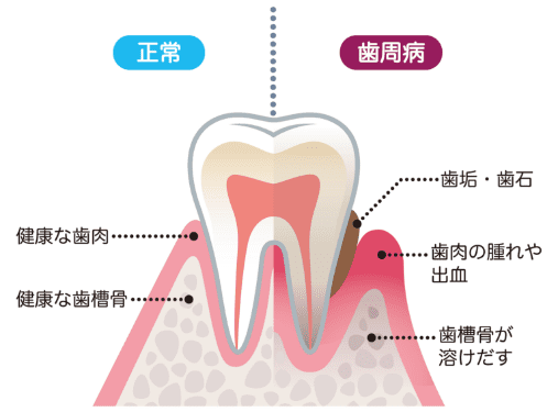 正常な歯と歯周病の歯の比較