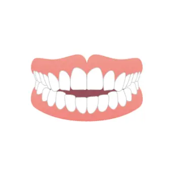 奥歯だけが噛んで前歯が開いている